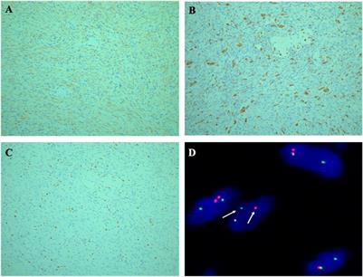 Case report: Large-size intramuscular nodular fasciitis, a challenging histopathologic diagnosis confirmed by molecular detection of USP6 gene rearrangement: Case report and literature review
